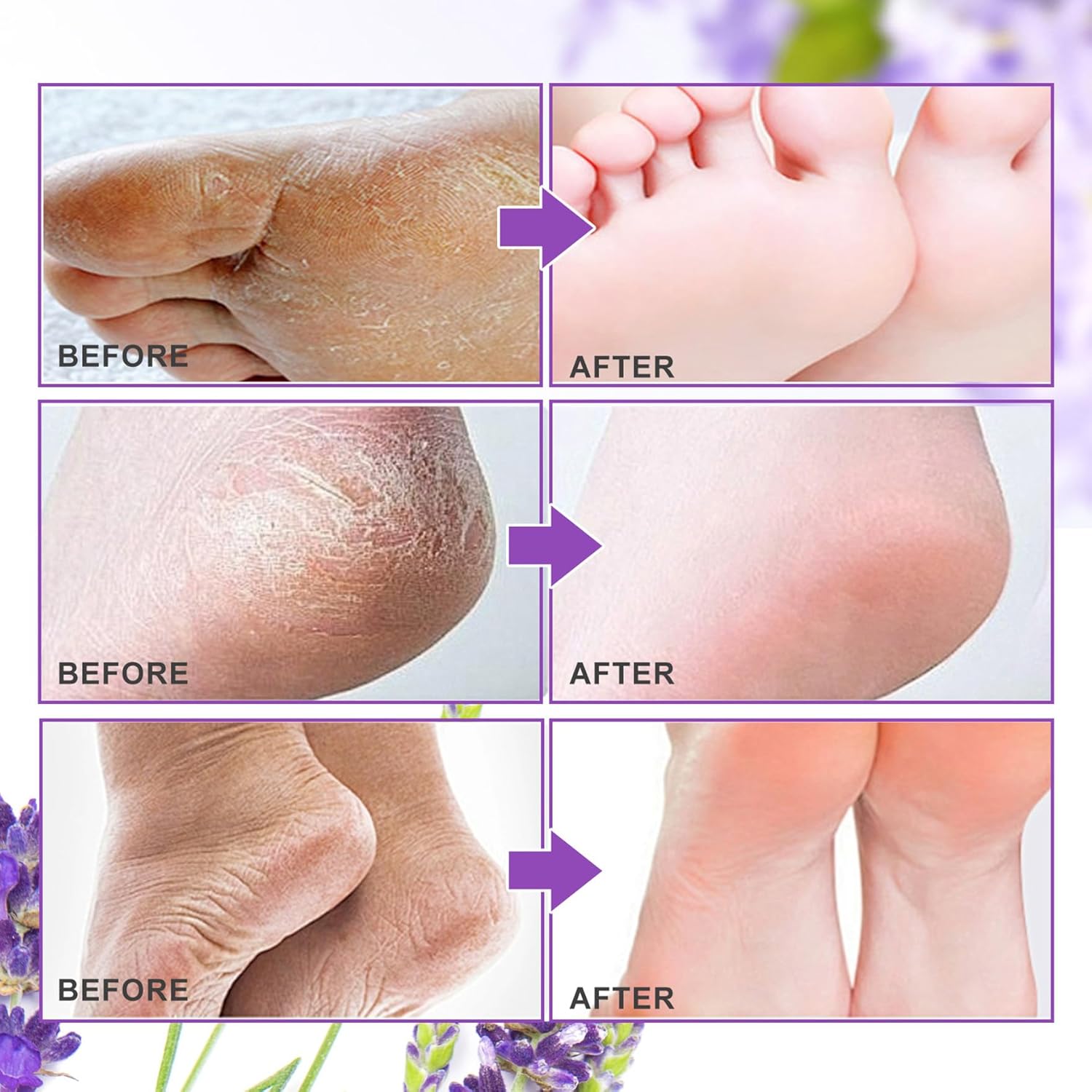 Exfoliante y removedor de callos para pies