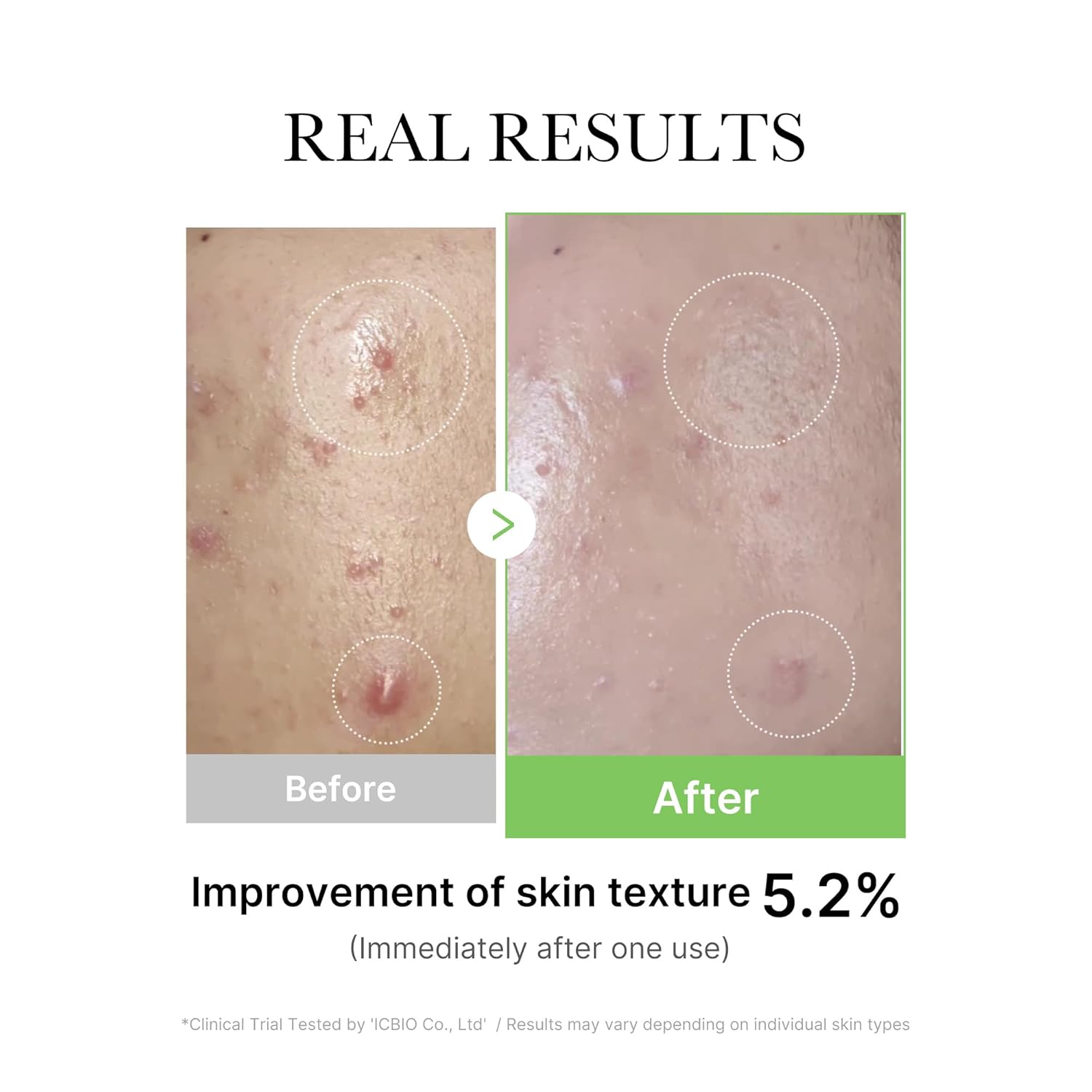 Serum Exosome Cica Ampoule piel sensible Medicube